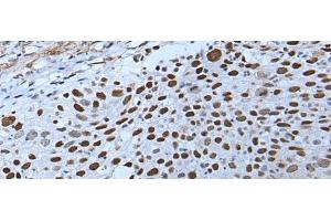 Immunohistochemistry of paraffin-embedded Human lung cancer tissue using ZNHIT3 Polyclonal Antibody at dilution of 1:80(x200) (ZNHIT3 Antikörper)