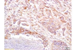 Formalin-fixed and paraffin embedded human lung carcinoma labeled with Anti PRSS8 Polyclonal Antibody (ABIN761891), Unconjugated at 1:200, followed by conjugation to the secondary antibody and DAB staining (PRSS8 Antikörper  (AA 65-165))