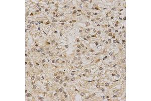 Immunohistochemistry of paraffin-embedded human kidney cancer using LETMD1 antibody at dilution of 1:200 (x400 lens) (LETMD1 Antikörper  (AA 161-360))