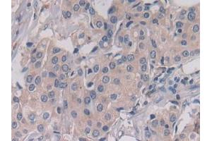 Detection of LGMN in Human Breast cancer Tissue using Polyclonal Antibody to Legumain (LGMN)