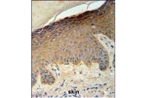 KRT35 Antibody (C-term) (ABIN651184 and ABIN2840116) IHC analysis in formalin fixed and paraffin embedded skin carcinoma followed by peroxidase conjugation of the secondary antibody and DAB staining. (Keratin 35 Antikörper  (C-Term))