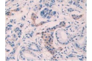 IHC-P analysis of Human Pancreas Cancer Tissue, with DAB staining. (IL10RB Antikörper  (AA 87-243))