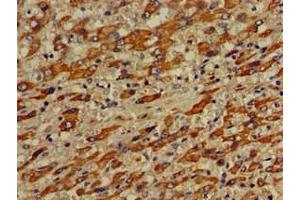 Immunohistochemistry of paraffin-embedded human liver cancer using ABIN7175308 at dilution of 1:100
