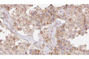 ABIN6277922 at 1/100 staining Human Melanoma tissue by IHC-P. (Cathelicidin Antikörper  (Internal Region))