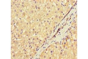 Immunohistochemistry of paraffin-embedded human liver cancer using ABIN7169570 at dilution of 1:100 (NEU1 Antikörper  (AA 201-415))