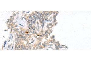 Immunohistochemistry of paraffin-embedded Human ovarian cancer tissue using CAMK2A Polyclonal Antibody at dilution of 1:55(x200) (CAMK2A Antikörper)
