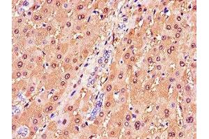 Immunohistochemistry of paraffin-embedded human liver tissue using ABIN7154085 at dilution of 1:100 (GSTA1 Antikörper  (AA 2-222))
