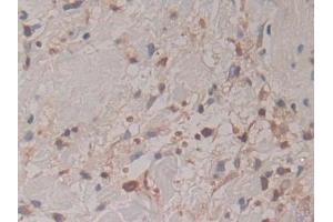 Detection of CYTH1 in Human Skin cancer Tissue using Polyclonal Antibody to Cytohesin 1 (CYTH1)