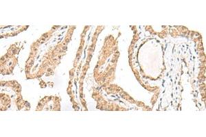 Immunohistochemistry of paraffin-embedded Human thyroid cancer tissue using RALGAPA1 Polyclonal Antibody at dilution of 1:55(x200) (GARNL1 Antikörper)