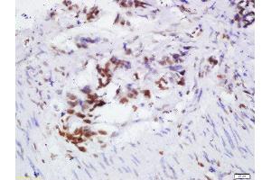 Formalin-fixed and paraffin embedded human colon cancer labeled with Rabbit Anti-OGG1 Polyclonal Antibody, Unconjugated 1:200 followed by conjugation to the secondary antibody and DAB staining (OGG1 Antikörper  (AA 151-250))