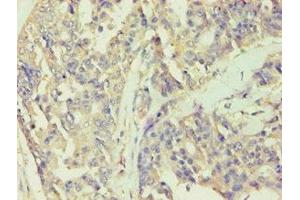 Immunohistochemistry of paraffin-embedded human endometrial cancer using ABIN7141988 at dilution of 1:100 (BCKDK Antikörper  (AA 153-412))