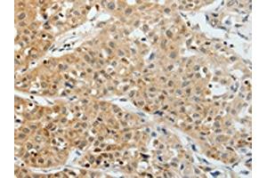 The image on the left is immunohistochemistry of paraffin-embedded Human lung cancer tissue using ABIN7193012(VEGFA Antibody) at dilution 1/25, on the right is treated with synthetic peptide. (VEGFA Antikörper)