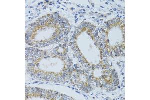Immunohistochemistry of paraffin-embedded human colon carcinoma using DNAJC19 antibody (ABIN1876363) at dilution of 1:100 (40x lens).