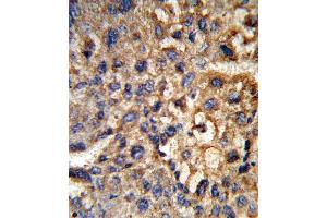 Formalin-fixed and paraffin-embedded human hepatocarcinoma reacted with HSD17B12 Antibody (Center), which was peroxidase-conjugated to the secondary antibody, followed by DAB staining. (HSD17B12 Antikörper  (AA 126-155))