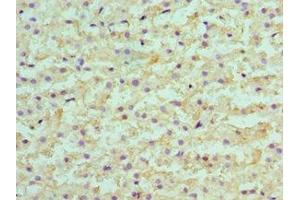Immunohistochemistry of paraffin-embedded human liver cancer using ABIN7145594 at dilution of 1:100