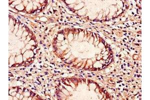 Immunohistochemistry of paraffin-embedded human colon cancer using ABIN7172286 at dilution of 1:100 (TLR9 Antikörper  (AA 425-563))