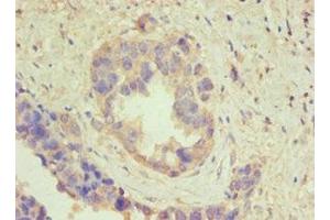 Immunohistochemistry of paraffin-embedded human endometrial cancer using ABIN7144840 at dilution of 1:100