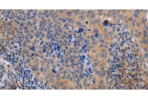 Immunohistochemistry of paraffin-embedded Human cervical cancer tissue using MAP3K13 Polyclonal Antibody at dilution 1:40 (MAP3K13 Antikörper)