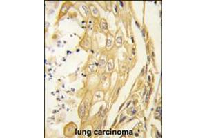 Formalin-fixed and paraffin-embedded human lung carcinoma tissue reacted with the EphB4 antibody , which was peroxidase-conjugated to the secondary antibody, followed by DAB staining. (EPH Receptor B4 Antikörper)