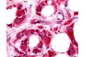 Anti-HUNK / B19 antibody IHC of human Breast, Carcinoma. (HUNK Antikörper  (Kinase Domain))
