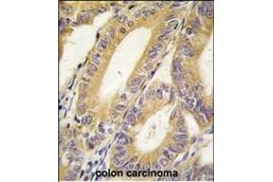 Formalin-fixed and paraffin-embedded human colon carcinoma tissue reacted with BIRC4 antibody (N-term) (ABIN390070 and ABIN2840594) , which was peroxidase-conjugated to the secondary antibody, followed by DAB staining. (XIAP Antikörper  (N-Term))