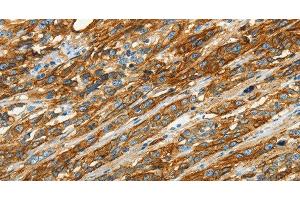Immunohistochemistry of paraffin-embedded Human esophagus cancer using CAV1 Polyclonal Antibody at dilution of 1:40 (Caveolin-1 Antikörper)