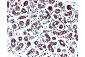 IHC staining of human breast cancer with Estrogen Inducible Protein pS2 antibody. (TFF1 Antikörper  (C-Term))