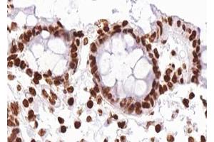ABIN6267280 at 1/100 staining human Colon carcinoma tissue sections by IHC-P.