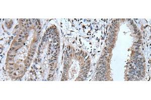 Immunohistochemistry of paraffin-embedded Human liver cancer tissue using UBA52 Polyclonal Antibody at dilution of 1:55(x200) (UBA52 Antikörper)