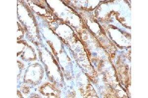 IHC testing of FFPE human renal cell carcinoma with Mitochondrial antibody (GFM1 Antikörper)