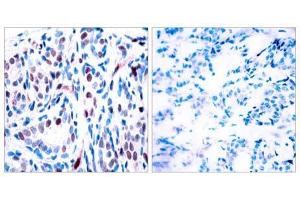 Immunohistochemical analysis of paraffin-embedded human breast carcinoma tissue using STAT3 (phospho-Tyr705) antibody (E011045). (STAT3 Antikörper  (pTyr705))