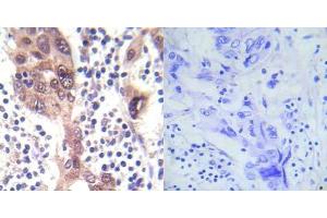 Immunohistochemical analysis of paraffin-embedded human breast carcinoma tissue using LKB1 (phospho- Ser428) antibody (E012046). (LKB1 Antikörper  (pSer428))