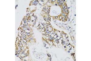 Immunohistochemistry of paraffin-embedded human gastric cancer using CHN1 antibody (ABIN5974737) at dilution of 1/100 (40x lens). (CHN1 Antikörper)