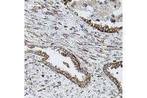 Immunohistochemistry of paraffin-embedded human lung cancer using SHH antibody (ABIN6291366) (40x lens).