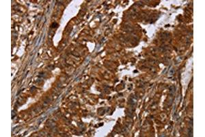 The image on the left is immunohistochemistry of paraffin-embedded Human esophagus cancer tissue using ABIN7191964(POU6F2 Antibody) at dilution 1/30, on the right is treated with synthetic peptide. (POU6F2 Antikörper)