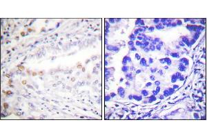 Immunohistochemistry analysis of paraffin-embedded human lung carcinoma tissue using Uba2 antibody. (UBA2 Antikörper)