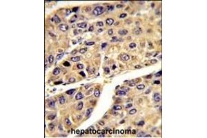 Formalin-fixed and paraffin-embedded human hepatocarcinoma reacted with IGFALS Antibody (Center), which was peroxidase-conjugated to the secondary antibody, followed by DAB staining. (IGFALS Antikörper  (AA 308-335))