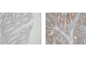 Left and Center: Immunohistochemical staining of normal colon tissue and colon carcinoma tissue using ATIC antibody . (ATIC Antikörper)