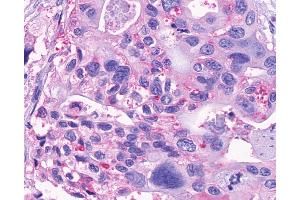 Anti-GPR150 antibody IHC of human Pancreas, Carcinoma.