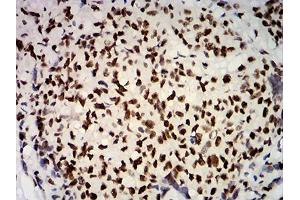 Immunohistochemical analysis of paraffin-embedded breast cancer tissues using ESR1 mouse mAb with DAB staining. (Estrogen Receptor alpha Antikörper  (AA 2-185))