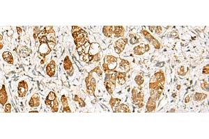 Immunohistochemistry of paraffin-embedded Human liver cancer tissue using RIMS3 Polyclonal Antibody at dilution of 1:60(x200) (RIMS3 Antikörper)