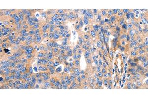 Immunohistochemistry of paraffin-embedded Human ovarian cancer tissue using IGFBP7 Polyclonal Antibody at dilution 1:50 (IGFBP7 Antikörper)