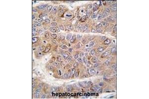 Formalin-fixed and paraffin-embedded human hepatocarcinoma tissue reacted with IRS2 antibody (C-term), which was peroxidase-conjugated to the secondary antibody, followed by DAB staining. (IRS2 Antikörper  (C-Term))