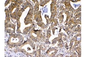 IHC testing of FFPE human rectal cancer tissue with PPID antibody at 1ug/ml. (PPID Antikörper)