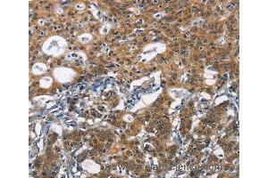Immunohistochemistry of Human liver cancer using DCC Polyclonal Antibody at dilution of 1:70 (DCC Antikörper)