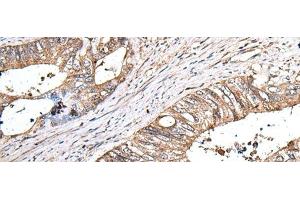 Immunohistochemistry of paraffin-embedded Human colorectal cancer tissue using ZNHIT1 Polyclonal Antibody at dilution of 1:40(x200) (ZNHIT1 Antikörper)
