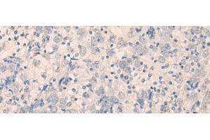 Immunohistochemistry of paraffin-embedded Human cervical cancer tissue using FAM91A1 Polyclonal Antibody at dilution of 1:35(x200) (FAM91A1 Antikörper)