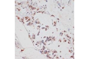 Immunohistochemistry of paraffin-embedded human gastric cancer using HT antibody (ABIN7267756) at dilution of 1:100 (40x lens). (HTATSF1 Antikörper  (AA 1-180))