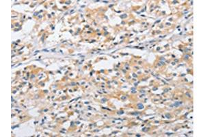 The image on the left is immunohistochemistry of paraffin-embedded Human thyroid cancer tissue using ABIN7128506(ARHGEF9 Antibody) at dilution 1/50, on the right is treated with fusion protein. (Arhgef9 Antikörper)