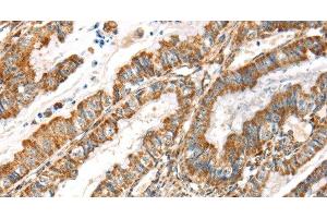 Immunohistochemistry of paraffin-embedded Human esophagus cancer tissue using LOXL4 Polyclonal Antibody at dilution 1:35